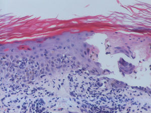 Piel con hiperqueratosis, afectación de la interfase dermoepidérmica con vesiculación subepidérmica, células inflamatorias mononucleares en su interior y necrosis de la epidermis suprayacente. Se observan fenómenos locales de regeneración. Infiltrado linfohistiocitario perivascular superficial en la dermis (hematoxilina-eosina x10).
