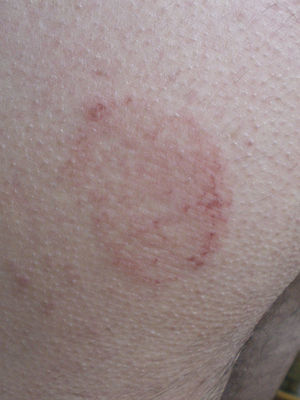 Lesión anular de 6cm de diámetro eritematosa, con áreas con pérdida de continuidad cutánea.