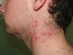 Acné polimorfo en el cuello con pápulas, pústulas y quistes.