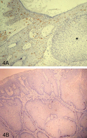 Importante disminución o casi desaparición en el número de células de Langerhans en la zona del carcinoma espinocelular (*) respecto a la zona adyacente al tumor (tinción CD1A ×100) (A). Carcinoma espinocelular de zona no fotoexpuesta (vulva). Se siguen observando numerosas células de Langerhans en la zona tumoral (tinción CD1a ×40) (B).