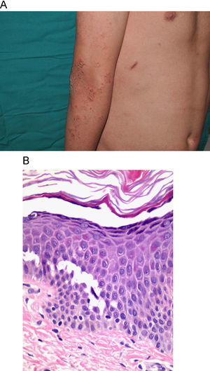 A) Lesiones erosivo-costrosas en la extremidad superior de un paciente con el síndrome de displasia ectodérmica-fragilidad cutánea. B) Imagen histológica de la misma enfermedad donde se aprecia acantólisis epidérmica suprabasal. (H&E 80x)