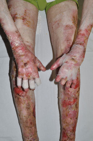Graves cicatrices distróficas en las cuatro extremidades y pérdida de la parte distal de los dedos en un paciente con una forma grave de epidermólisis ampollosa distrófica recesiva.