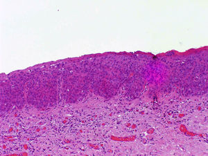 Atipia marcada que afecta a todo el espesor de la epidermis (hematoxilina-eosina x 100).