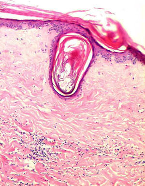 Tapones córneos y en la dermis superior edema con homogenización del colágeno y un infiltrado inflamatorio crónico dispuesto en banda (hematoxilina-eosina, ×100).