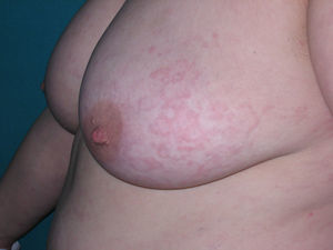 Placas urticarianas con patrón reticular en la mama.