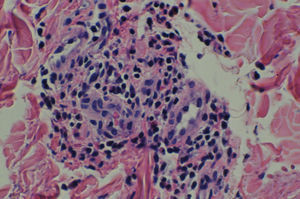 Imagen histológica de las lesiones urticarianas mostrando un infiltrado perivascular de linfocitos y neutrófilos con leucocitoclasia (hematoxilina-eosina, ×200).