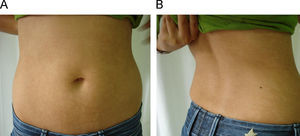 Caso clínico 2; lesiones maculares hipopigmentadas en el abdomen (A) y en los flancos y la zona lumbar (B).