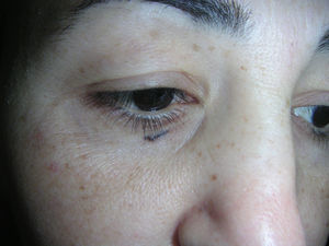 Linear pigmented lesion on the right lower eyelid.
