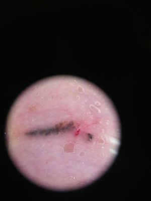 Dermoscopic aspect.
