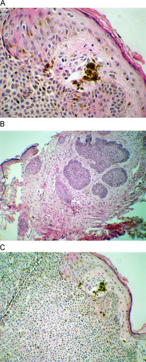 (A) Superficial and pigmented basal cell carcinoma (hematoxylin–eosin, ×400). (B) Nodular basal cell carcinoma (hematoxylin–eosin, ×250). (C) Pigmentation in tumor and in stoma of basal cell carcinoma (hematoxylin–eosin, ×400).