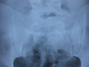 Sacroileitis unilateral en RX simple anteroposterior de paciente con APso.