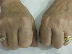Sinovitis de 2.a y 3.a articulación MCF mano derecha de paciente con APso.
