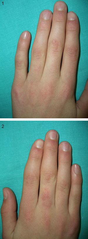 Tumefacción de la cara lateral de articulaciones IFP de 2.o, 3.o y 4.o dedos de ambas manos, más evidente en mano derecha (fig. 2).