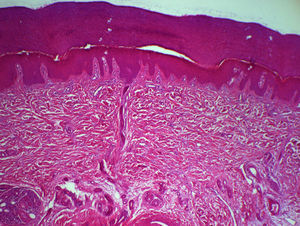 Hiperqueratosis con ortoqueratosis compacta. Engrosamiento de dermis, con aumento del número de fibras de colágena y fibroblastos. Ligero aumento de mucinas, sin infiltrados inflamatorios significativos (HE, ×40).