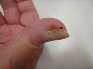 Lesión excrecente en lateral externo de la uña con superficie mínimamente erosiva.