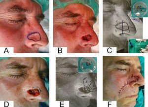 A) Exéresis mediante cirugía micrográfica de Mohs en fresco (CMF) de carcinoma basocelular nasal derecho. B, C) Primer pase de exéresis de la pieza tumoral con mapeo en 4 fragmentos. El resultado histológico demostró afectación neoplásica en margen superficial de fragmento 2. D, E) Segundo pase de exéresis Mohs (ampliación de márgenes en fragmento 2). El resultado histológico fue de márgenes libres. F) Reconstrucción quirúrgica.
