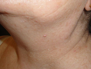 En la región submandibular y lateral del cuello pápulas blanquecinas similares a las de la cara en menor número.