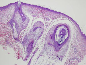Hematoxilina-eosina 10x. En el centro folículos pilosos distorsionados rodeados por un estroma laxo basófilo, mucoide. De la pared del folículo distorsionado salen estrechos cordoncillos de células epiteliales foliculares que se anastomosan entre sí y con la pared.