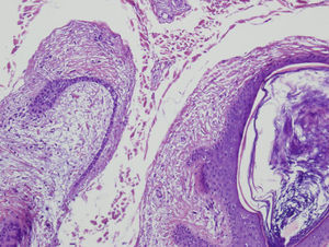 Hematoxilina-eosina 40×. A mayor detalle los cordones de células epiteliales foliculares.
