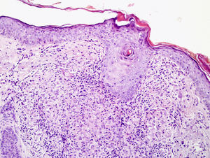 H&Ex20. Se objetivan formaciones granulomatosas perifoliculares con células epitelioides con corona linfocitaria con necrosis central.