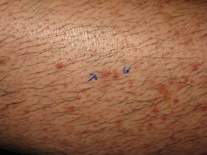 Lesiones purpúricas perifoliculares en las piernas en el caso 1.