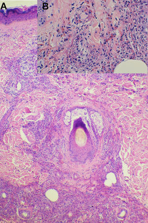 A) Vasculitis leucocitoclástica alrededor de un folículo pilosebáceo (hematoxilina-eosina, x40). B) Detalle de la figura A mostrando hemorragia y leucocitoclasia (hematoxilina-eosina, x200).
