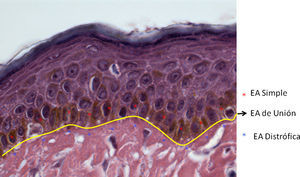 Membrana basal epidérmica y ubicación de los tipos principales de epidermólisis ampollosa H y E (100×).