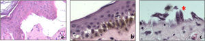 a) Ampolla sub epidérmica carente de células inflamatorias característica de cualquier forma de epidermólisis ampollosa H y E 20×. b) Ampolla basal característica de la EA simple H y E 20×. c) Dos queratinocitos remanentes adheridos a la membrana basal en EA simple (*) H y E 60×.