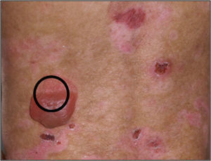 Sitio ideal para realizar una biopsia para inmunofluorescencia.