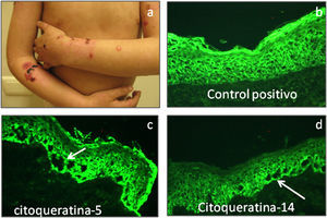 a) Manifestaciones clínicas de un pacientes con EAS. b) Control positivo de piel sana teñido para citoqueratina 5 (20×) c y d) citoqueratina 5 y 14 las cuales muestran ampollas intraepidérmicas basales (20×).