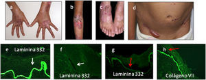 a–d) Pacientes con EAU-nH generalizada; ampollas hemorrágicas, onicodistrofia, ampollas tensas y costras hemorrágicas. e y f) laminina 332 control (20×). f) Laminina 332 ausente característico de EAU-Herlitz (20×) l. g) Laminina-5 reducida en intensidad (20×) y h) colágeno tipo vii (20×) de intensidad normal en el piso de la ampolla (flechas rojas) característico de EAU-nH gen.