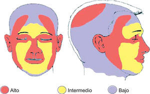 Área H: «área de la máscara» (zona central del rostro, párpados, cejas, región periorbitaria, nariz, labios [cutánea y bermellón], barbilla, mandíbula, áreas pre y retroauricular), genitales, manos y pies. Área L: mejillas, frente, cuero cabelludo y cuello. Área M: Tronco y extremidades. Fuente: Modificado de NCCN Clinical Practice Guidelines in Oncology 20096.