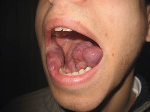 Tumoración blanda y de tonos azulados localizada en mucosa yugal derecha y lengua.