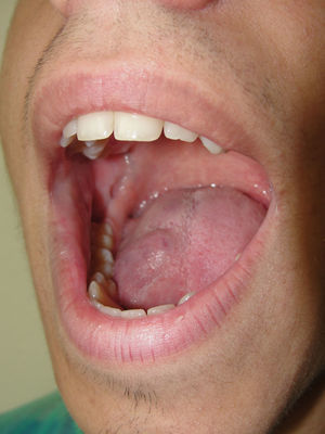 Disminución marcada tras tratamiento láser con resolución en mucosa yugal.