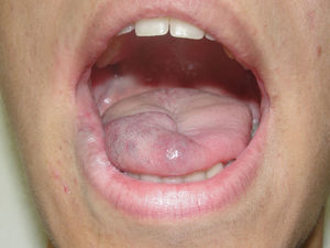Disminución marcada tras tratamiento láser con casi completa resolución en región lingual.