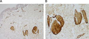 Inmunohistoquímica. A) Distribución y disposición irregular de los fascículos de músculo liso dérmico (actina músculo específica, ×40). B) A mayor detalle (actina músculo específica, ×100).