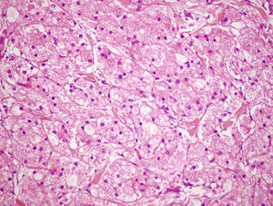 Tumoración formada por células poligonales con citoplasma abundante, granular y eosinófilo, pas+diastasa resistente. Hematoxilina-eosina (40×).