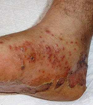 Queratodermia blenorrágica en el pie derecho.