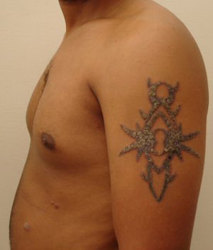 Fenómeno de Koebner en el brazo del paciente, dos semanas después de realizar el tatuaje.