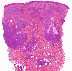 Infiltrado denso de predominio perianexial y perivascular en dermis media y profunda (hematoxilina-eosina ×16).