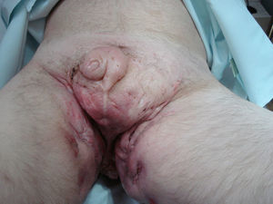 Fístulas y cicatrices de hidrosadenitis supurativa en área genital.