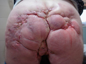 Fístulas y cicatrices de hidrosadenitis supurativa en área perineal.