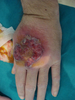 Pioderma gangrenoso ulcerativo en dorso de mano.