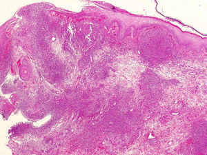 Úlcera epitelial y abcesos neutrofílicos en dermis sugestivos de pioderma gangrenoso (H-E, ×20).