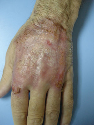 Cicatriz residual de pioderma gangrenoso tras 2 meses de tratamiento.