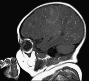 RM cerebral corte sagital con múltiples tuberomas corticales.