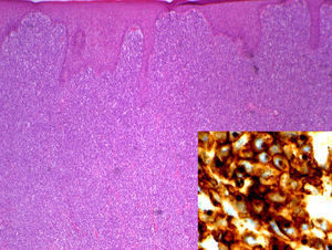 Dermis ocupada por una proliferación linfoide atípica que respeta la epidermis y borra los anejos (hematoxilina-eosina ×40). En recuadro inferior derecho se muestra positividad para CD-30 (ki-1) en más del 90% de las células tumorales.