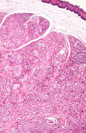 HE×40. Neoplasia multilobulada, recubierta por mucosa indemne y adyacente a estructuras de glandulas salivares conservadas, constituida por islotes sólidos que infiltran en profundidad.