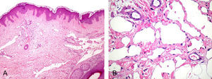 A) Proliferación vascular dérmica, los canales tienden a horizontalizarse y estrecharse en profundidad adoptando un aspecto de «disección de colágeno» (hematoxilina-eosina ×100). B) Paredes vasculares finas con una capa simple de células endoteliales planas, sin atipias ni mitosis (hematoxilina-eosina ×250).