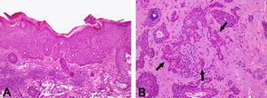 A) Carcinoma basocelular superficial en el primer estadio de Mohs (hematoxilina-eosina ×100). B) Persistencia tumoral (flechas), infiltrado dérmico de células basaloides dispuestas entre los folículos pilosos (hematoxilina-eosina ×250).